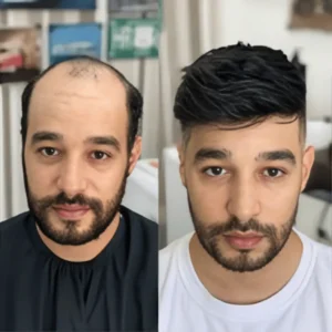 Hair restoration near NICE Road Bangalore