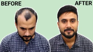 Professional hair extensions Bilekahalli Bangalore